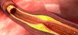 Was ist Arteriosklerose?
