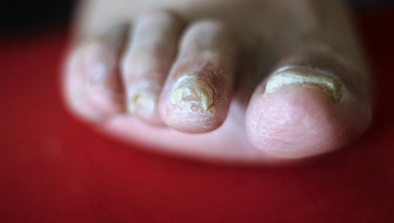 Dermatophyten (Fadenpilze)
