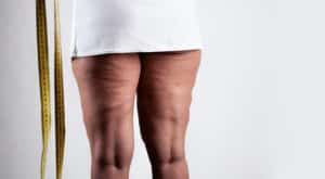 Cellulite