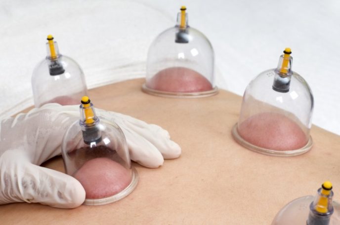 Schröpfkopfmassage